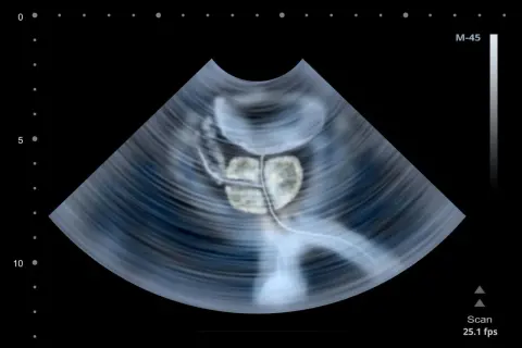 Badanie prostaty per rectum: Bez obaw! Przewodnik krok po kroku