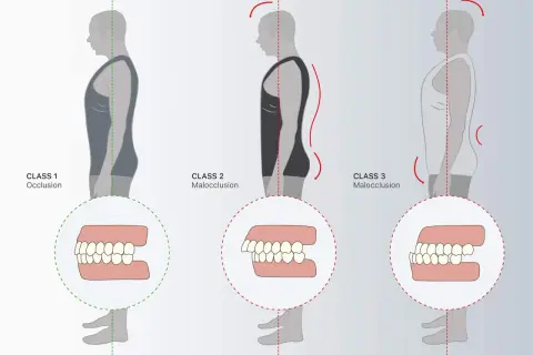 Classi di occlusione dentale: 1 (normale), 2 (malocclusione) e 3 (malocclusione), con profili posturali associati.