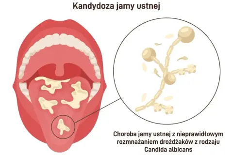 Ilustracja pokazuje jamę ustną z nalotem na języku, powiększony obraz drożdżaków Candida. Dowiedz się, jak pozbyć się candidy.