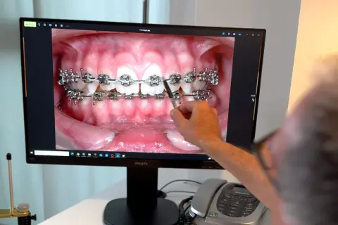 Primo piano di un monitor che mostra un primo piano di denti con apparecchio fisso trasparente. Una mano indica i denti.
