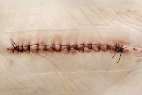 Gros plan d'une plaie suturée, où un fil de suture reste dans la plaie, témoignant du processus de guérison.