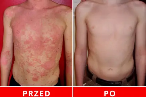 Łuszczyca: Metody leczenia w Polsce od maści po terapie biologiczne