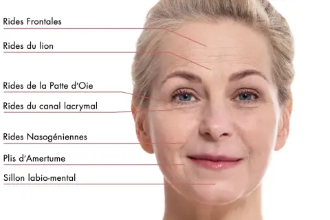Visage d'une femme montrant les rides frontales, du lion, pattes d'oie, nasogéniennes, plis d'amertume et sillon labio-mental.