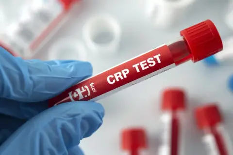 Ręka w niebieskiej rękawiczce trzyma probówkę z napisem "CRP TEST". To badanie pozwala ocenić poziom białka c-reaktywnego, wskaźnika stanu zapalnego.