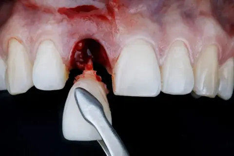 Krwawienie po wyrwaniu zęba: co jest normą, a kiedy do dentysty?