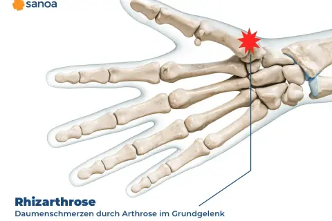 Skelett der Hand mit hervorgehobenem Daumengrundgelenk, das auf Schmerzen im Daumengelenk durch Rhizarthrose hinweist.