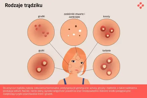 Ilustracja przedstawia różne rodzaje zaskórników i wyprysków trądzikowych: grudki, guzki, zaskórniki otwarte i zamknięte, krosty i torbiele.