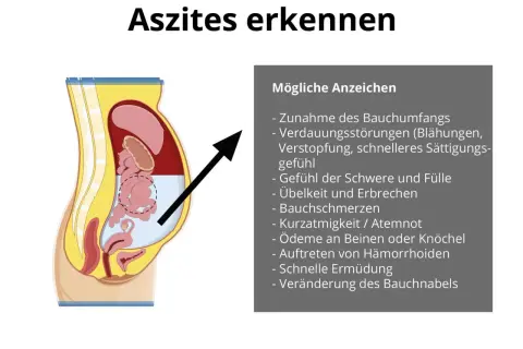 Illustration zeigt Bauchraum mit Flüssigkeitsansammlung. Symptome wie Bauchumfangszunahme und Völlegefühl deuten auf Wasser im Bauch hin.