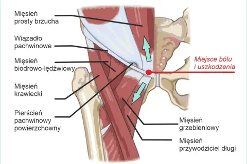 Anatomia pachwiny z zaznaczonym miejscem bólu i uszkodzenia. Widoczne mięśnie: prosty brzucha, biodrowo-lędźwiowy, krawiecki, grzebieniowy, przywodziciel długi.