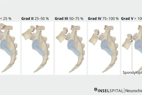 Illustrationen zeigen fünf Grade der Spondyloptose, von Grad I (<25%) bis Grad V (>100%), die den **Meyerding Grad 1 Behinderungsgrad** und weitere Stufen darstellen.