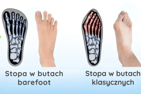 Haluksy: Geny czy buty? Odkryj prawdziwe przyczyny deformacji