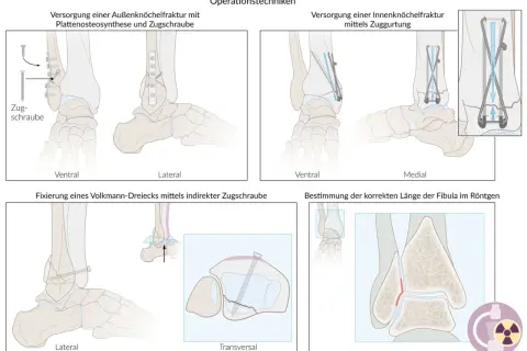 Fixierung eines Volkmann-Dreiecks mit indirekter Zugschraube am Sprunggelenk. Illustration zeigt die laterale und transversale Ansicht.