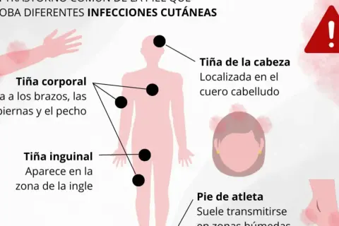 Ilustración muestra tiña corporal, inguinal y de cabeza, con sus síntomas y zonas afectadas. Alerta de salud.