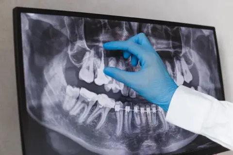 Dentysta w niebieskiej rękawiczce wskazuje na zdjęcie RTG zębów, analizując sytuację przed powtórnym leczeniem kanałowym.