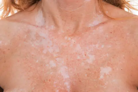 Poitrine et cou d'une personne présentant des taches blanches sur la peau, probablement dues à une exposition au soleil.