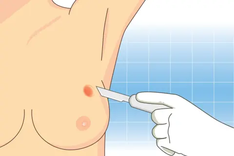 Wykonanie biopsji: chirurg w białej rękawiczce skalpelem pobiera wycinek z piersi.