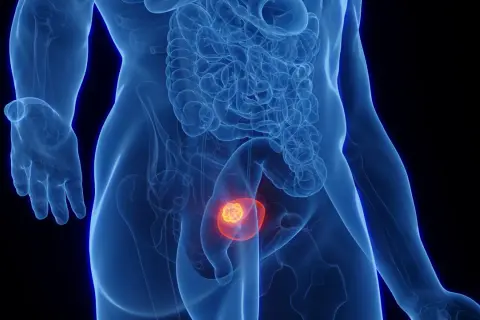 Anatomical illustration of a bladder with a tumor highlighted in red and yellow.