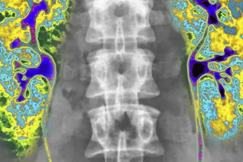 Scyntygrafia kości: kolorowe plamy na tle kręgosłupa, wskazujące na aktywność metaboliczną tkanki kostnej.
