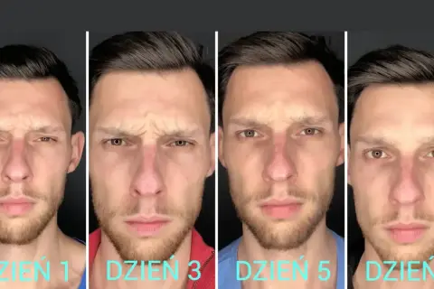 Bruksizm: seria zdjęć mężczyzny od Dnia 1 do Dnia 7 po zabiegu botoksem, pokazująca redukcję zmarszczek na czole.