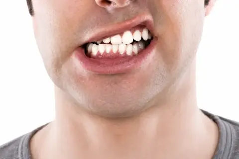 Primo piano di un uomo con denti visibili, che mostra una possibile malocclusione dentale adulti.