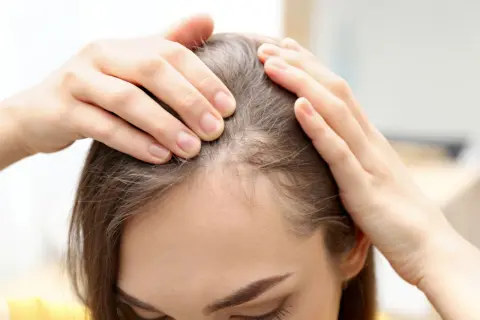 Manos revisando el cuero cabelludo, buscando soluciones sobre como evitar la caida del pelo.