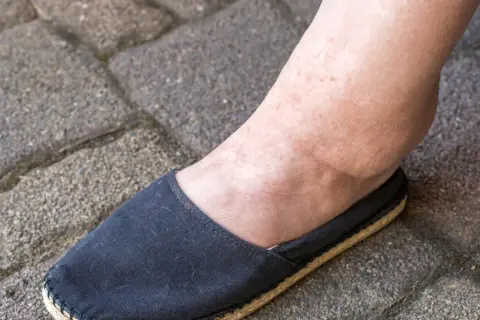 Obrzęk kostki, jeden z objawów marskości nerki, widoczny na nodze w czarnym bucie na tle kostki brukowej.