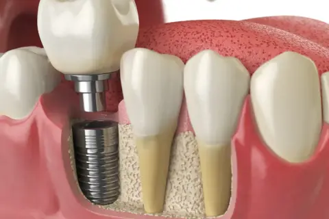 Widok przekroju dziąsła po wszczepieniu implantu zębowego. Implant jest widoczny w kości, a na nim osadzona jest korona.