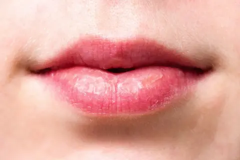 Labios rosados con piel seca y descamada, evidencia de labios quemados por el sol tras un día soleado.