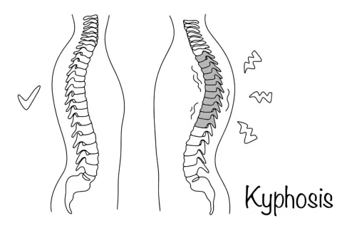 Confronto tra colonna vertebrale sana e cifosi. La cifosi causa posture curve, rendendo le persone gobbe.
