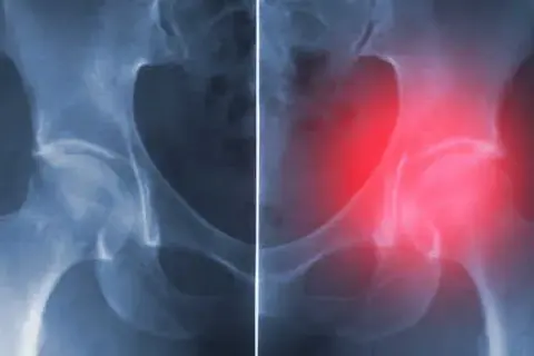 Jakie endoprotezy stawu biodrowego refunduje NFZ i co musisz wiedzieć