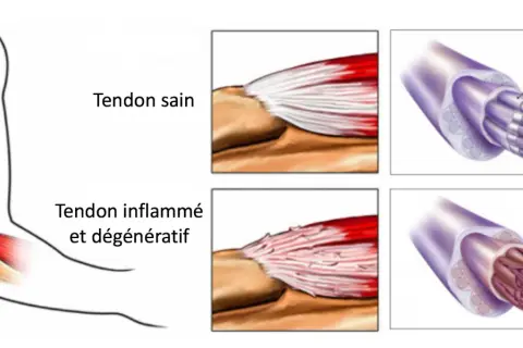 Comparaison d'un tendon sain et d'un tendon inflammé, montrant les fibres déchirées typiques du tennis elbow.