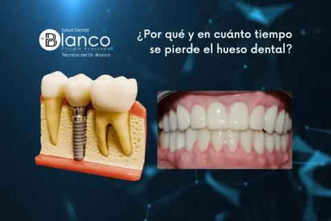 Modelo de implante dental y encías sanas. La imagen aborda la **pérdida hueso dental** y su tiempo.