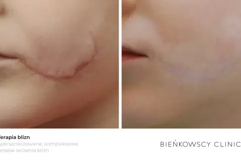 Przed i po laserowym usuwaniu blizn na twarzy. Widoczna znacząca poprawa wyglądu skóry.