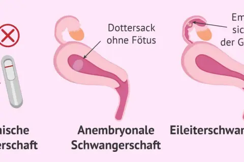 Anzeichen für eine Fehlgeburt: Biochemische Schwangerschaft, Dottersack ohne Fötus, Embryo nistet sich außerhalb der Gebärmutter ein.