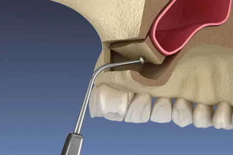 Ilustración de elevación de seno maxilar, mostrando el instrumento dental y la anatomía ósea.