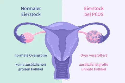 Porównanie jajnika: normalny vs. przy PCOS. Zwiększony jajnik z licznymi niedojrzałymi pęcherzykami to jeden z objawów PCOS.