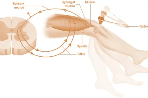 Schema del riflesso patellare. Un martelletto colpisce il ginocchio, causando un'estensione rapida dovuta all'ipertonia muscolare.