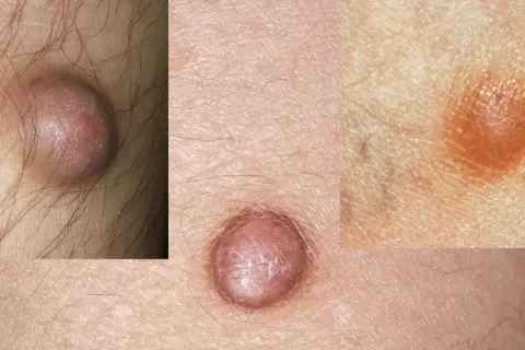 Nahaufnahme von Hautveränderungen, die auf fibrose Hautbilder hinweisen. Kleine, erhabene Knötchen auf der Haut.
