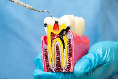 Model zęba pokazuje, co to endodoncja: leczenie kanałowe zniszczonej miazgi.