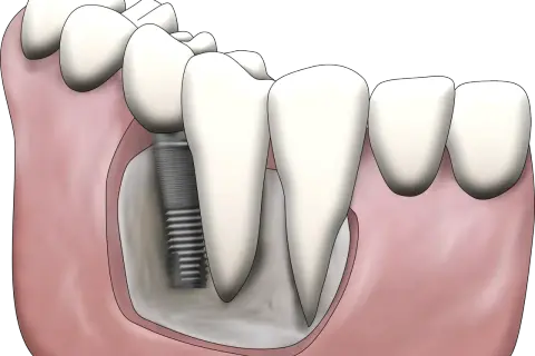 Ilustracja pokazuje, jak uzupełnić brak tylnych zębów za pomocą implantu stomatologicznego. Implant jest wkręcony w kość szczęki, a na nim osadzona jest korona zęba.