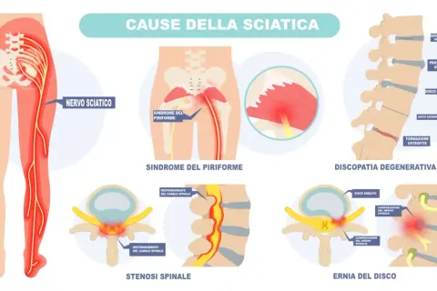Illustrazione delle cause della sciatica: sindrome del piriforme, discopatia degenerativa, stenosi spinale ed ernia del disco che comprimono il nervo sciatico.