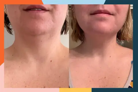 Before and after neck training: The left image shows a softer jawline and neck, while the right image displays a more defined jawline and smoother neck.