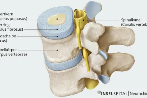Querschnitt einer Bandscheibe mit Gallertkern und Faserring, die auf einen Spinalkanal drückt. Dies zeigt eine breitbasige Bandscheibenprotrusion.