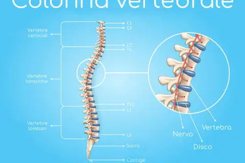 Illustrazione della colonna vertebrale con dettagli su vertebre cervicali, toraciche e lombari. Un ingrandimento mostra nervi e dischi, utili per comprendere la spondilo artrosi.