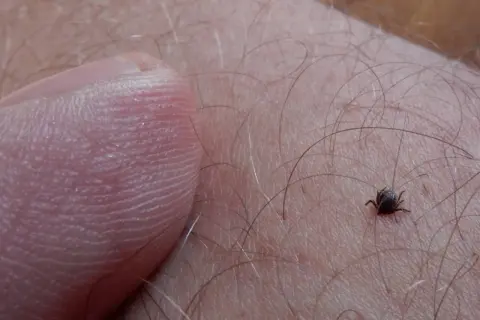 Mały kleszcz na skórze, obok palca. Może to być początek gorączki po ugryzieniu kleszcza.