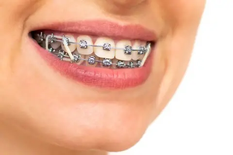 Sorriso con apparecchio ortodontico e elastici intermascellari, per un allineamento perfetto dei denti.