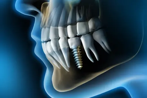Implante dental en el hueso maxilofacial, mostrando la estructura ósea y los dientes.