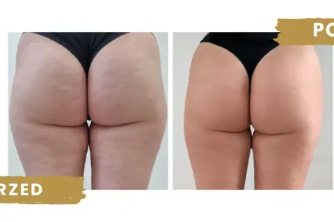 Endermologia: Jak często dla najlepszych efektów? Pełny plan