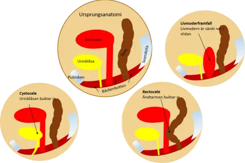 Illustrationer visar hur livmoderframfall, cystocele och rektosele ser ut.