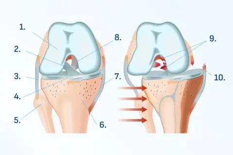 Ilustracja anatomiczna stawu kolanowego, pokazująca zdrową strukturę i uszkodzenie więzadła.